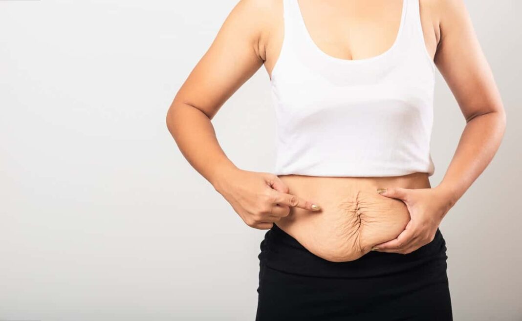5 načina kako da skinete stomak nakon porođaja