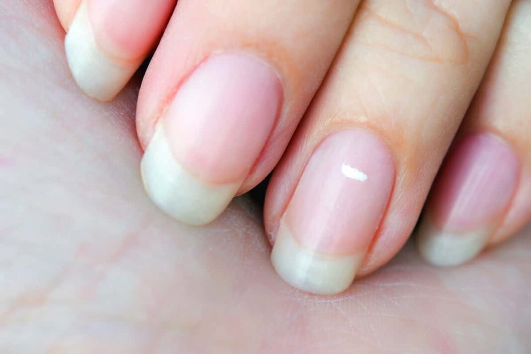 Zašto se javljaju bele fleke na noktima?